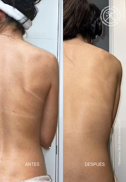 Zitback - Σπρέι Κατά της Ακμής στο Σώμα