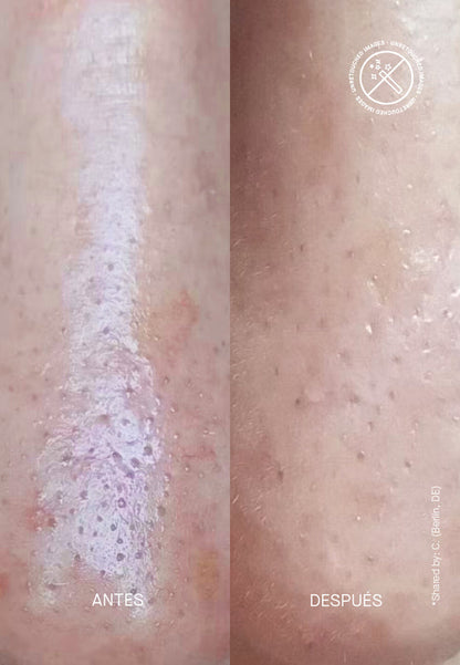 Zitproof Nose - Patches Κατά των Μαύρων Στιγμάτων στη Μύτη