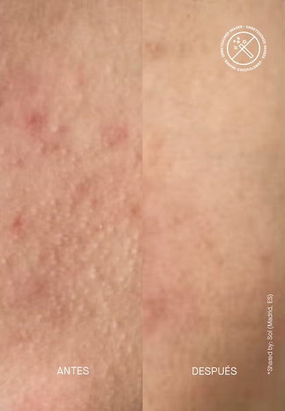 Zitmask Anti-Blemish Sulfur Mask - Μάσκα για Προβληματική Επιδερμίδα BHA + Θείο