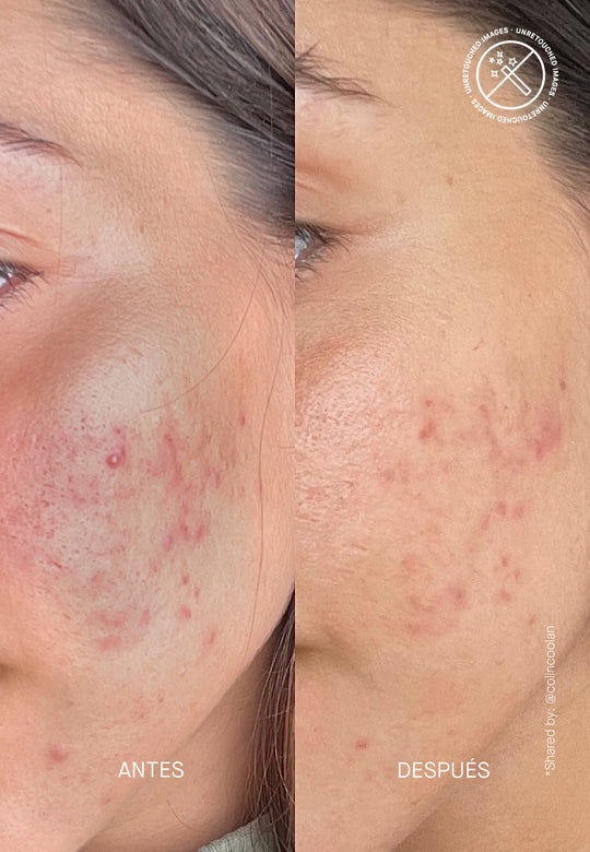 Azid - 15% Azelaic Acid